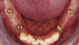 Locator Attachment on Implant